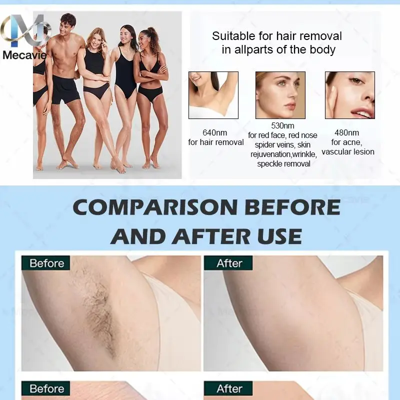 Soprano System Beauty Instrument 808 Diode Laser Hair Removal Tattoo Removal Skin Tightening Photorejuvenation Black Instrument
Soprano System Beauty Instrument 808 Diode Laser Hair Removal Tattoo Removal Skin Tightening Photorejuvenation Black Instrument