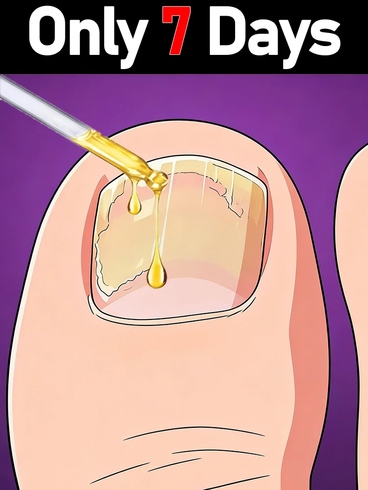 Сыворотка для восстановления ногтей, изготовленная на основе натуральных растительных экстрактов, удаляет грибок ногтей, лечит паронихию и восстанавливает потемневшие ногти.
Сыворотка для восстановления ногтей, изготовленная на основе натуральных растительных экстрактов, удаляет грибок ногтей, лечит паронихию и восстанавливает потемневшие ногти.