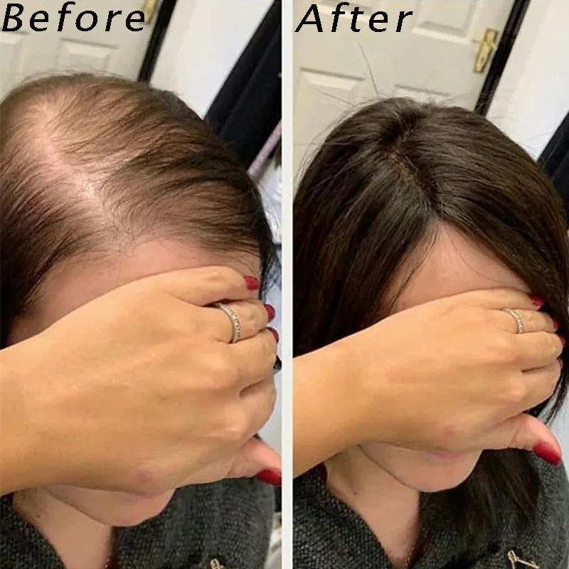 2.5x4 Inches Toupee Hair For Women Hair Toppers For Women Human Hair Clip Ins Natural Color 130% Volume Extension Rosa Queen
2.5x4 Inches Toupee Hair For Women Hair Toppers For Women Human Hair Clip Ins Natural Color 130% Volume Extension Rosa Queen