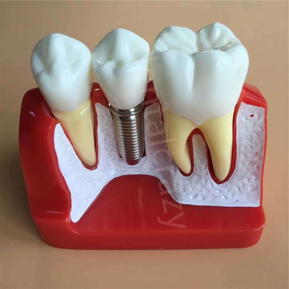 Dental Teach Implant Analysis Crown Bridge Removable Model Dental Demonstration Teeth Model
Dental Teach Implant Analysis Crown Bridge Removable Model Dental Demonstration Teeth Model