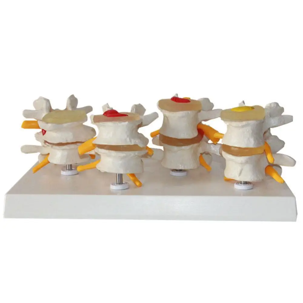 medical Human anatomy skeleton Spine 4-stages lumbar vertebrae model Human Lumbar Lesion Spinal Statue Display Model
medical Human anatomy skeleton Spine 4-stages lumbar vertebrae model Human Lumbar Lesion Spinal Statue Display Model