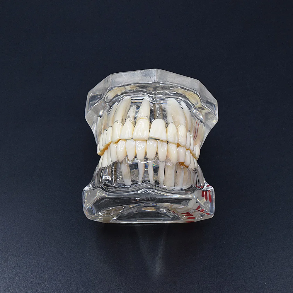 Dental Implant Disease Teeth Model 1pcs With Restoration Bridge Tooth Dentist For Medical Science Dental Disease Teaching Study
Dental Implant Disease Teeth Model 1pcs With Restoration Bridge Tooth Dentist For Medical Science Dental Disease Teaching Study