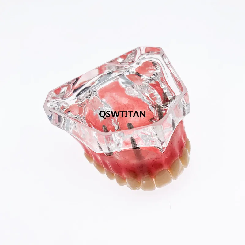 Dental Teeth Model Upper jaw Overdenture Superior With 4 Implants for Teaching Study
Dental Teeth Model Upper jaw Overdenture Superior With 4 Implants for Teaching Study