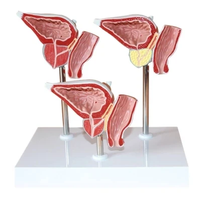 prostate Pathological changes model Benign prostatic hyperplasia free shipping
prostate Pathological changes model Benign prostatic hyperplasia free shipping
