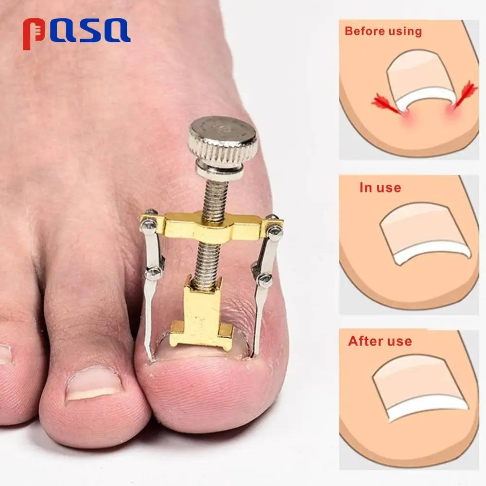 Hot Sale Ingrown toenails pedicure foot nail care tools file for feet orthotic acronyx ingrowing nail onyxis corrector for toes
Hot Sale Ingrown toenails pedicure foot nail care tools file for feet orthotic acronyx ingrowing nail onyxis corrector for toes