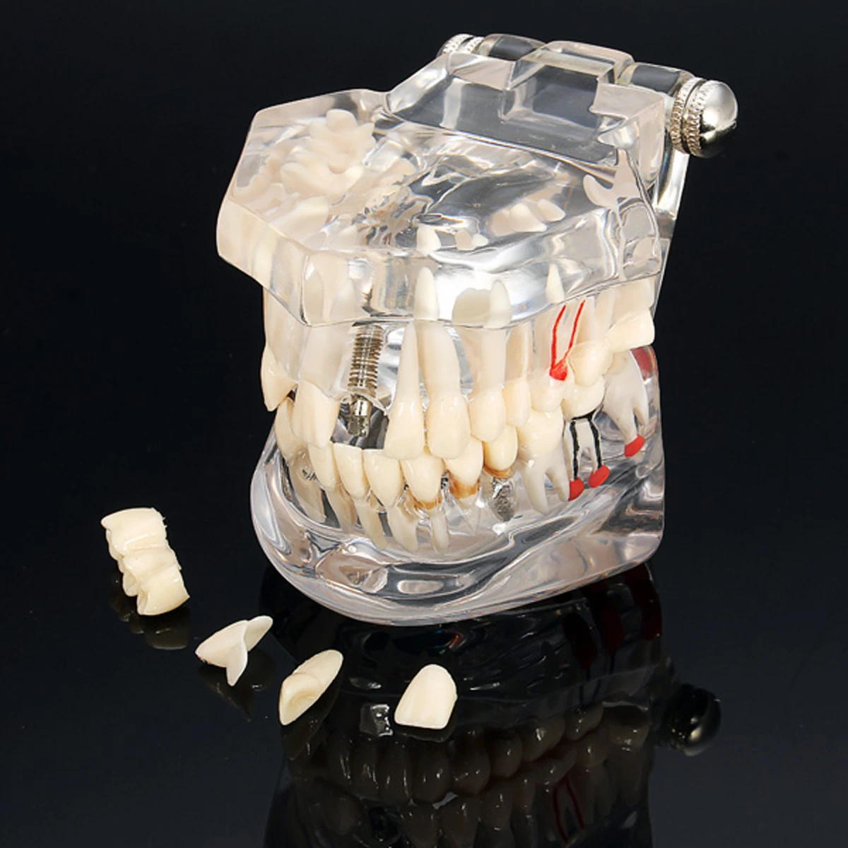 Dental Implant Disease Teeth Model With Restoration Bridge Tooth Dentist For Medical Science Dental Disease Teaching Study Tool
Dental Implant Disease Teeth Model With Restoration Bridge Tooth Dentist For Medical Science Dental Disease Teaching Study Tool