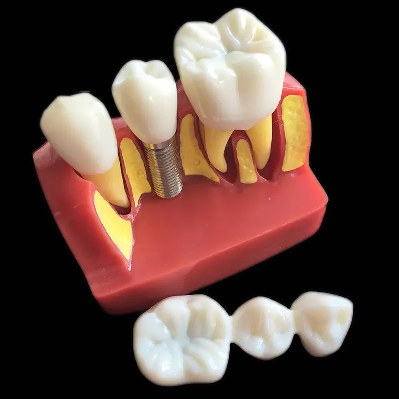 1 PC 4-times Implant Disease Teeth Model Oral Teaching Model Dental Pathology Model
1 PC 4-times Implant Disease Teeth Model Oral Teaching Model Dental Pathology Model