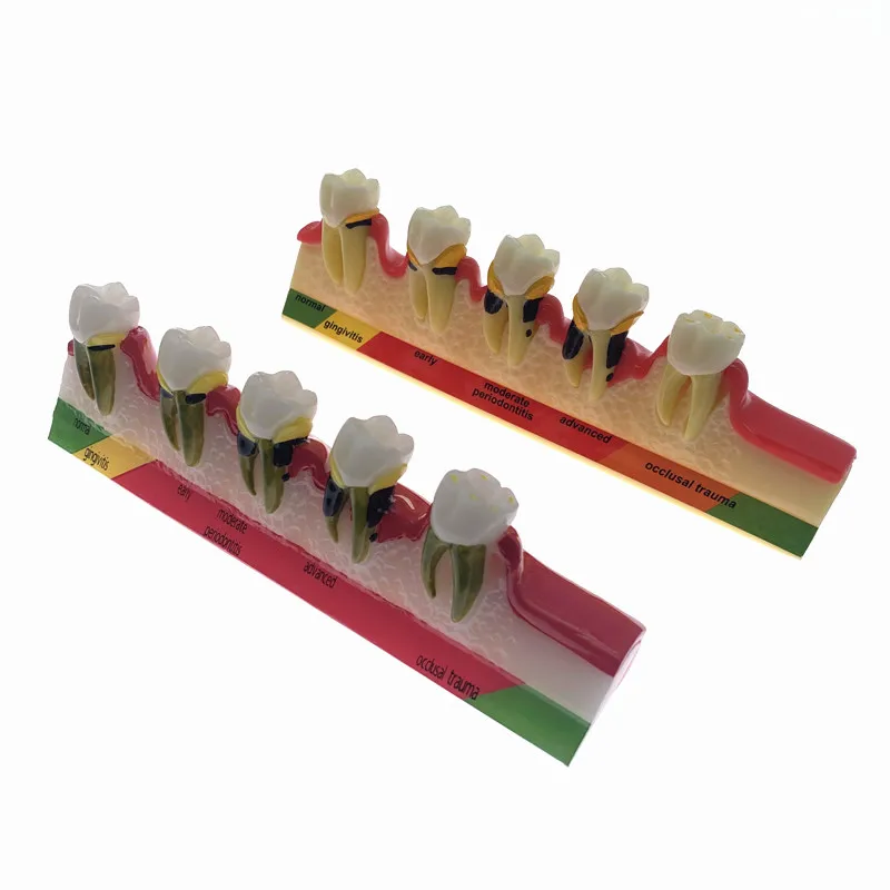 Odontologia Periodontal Disease Dental Teeth Model Tooth research model for dentistry students
Odontologia Periodontal Disease Dental Teeth Model Tooth research model for dentistry students