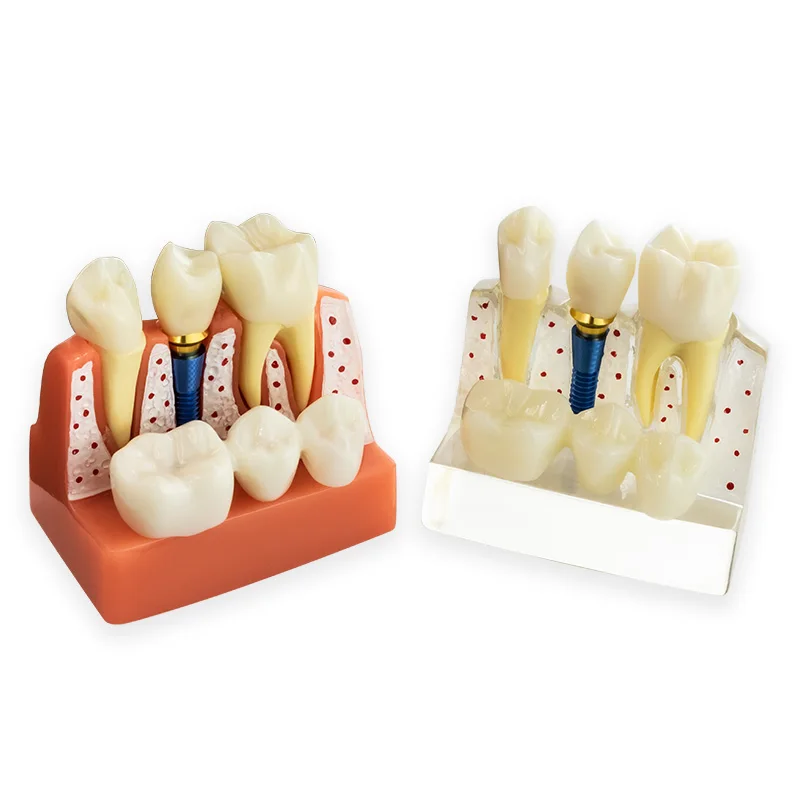 Dental Model 4 Times Dental Implant Analysis Crown Bridge Demonstration Dental Teeth Model Dentist teaching Dentistry clinic
Dental Model 4 Times Dental Implant Analysis Crown Bridge Demonstration Dental Teeth Model Dentist teaching Dentistry clinic