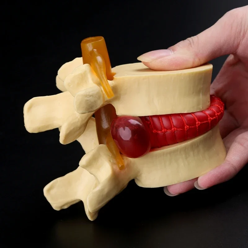 2 Colors Anatomical Spine Lumbar Disc Herniation Anatomy Study Medical Props Anatomy Model Tool Kit Nursing Science Supplies
2 Colors Anatomical Spine Lumbar Disc Herniation Anatomy Study Medical Props Anatomy Model Tool Kit Nursing Science Supplies