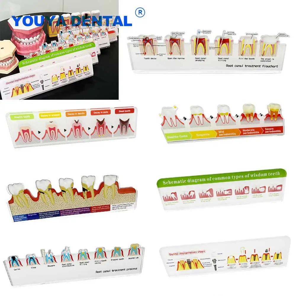Endodontic Treatment Diaplay Flowchart Stand Restoration Pathological Tooth Model Dentist Teaching Study Demo Clinic Decoration
Endodontic Treatment Diaplay Flowchart Stand Restoration Pathological Tooth Model Dentist Teaching Study Demo Clinic Decoration