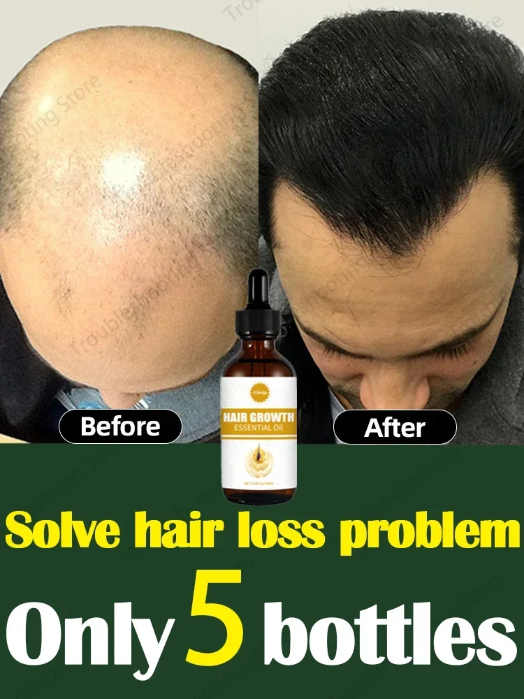 O óleo de crescimento capilar faz o cabelo crescer rapidamente, repara eficazmente a calvície e a queda de cabelo hereditária
O óleo de crescimento capilar faz o cabelo crescer rapidamente, repara eficazmente a calvície e a queda de cabelo hereditária
