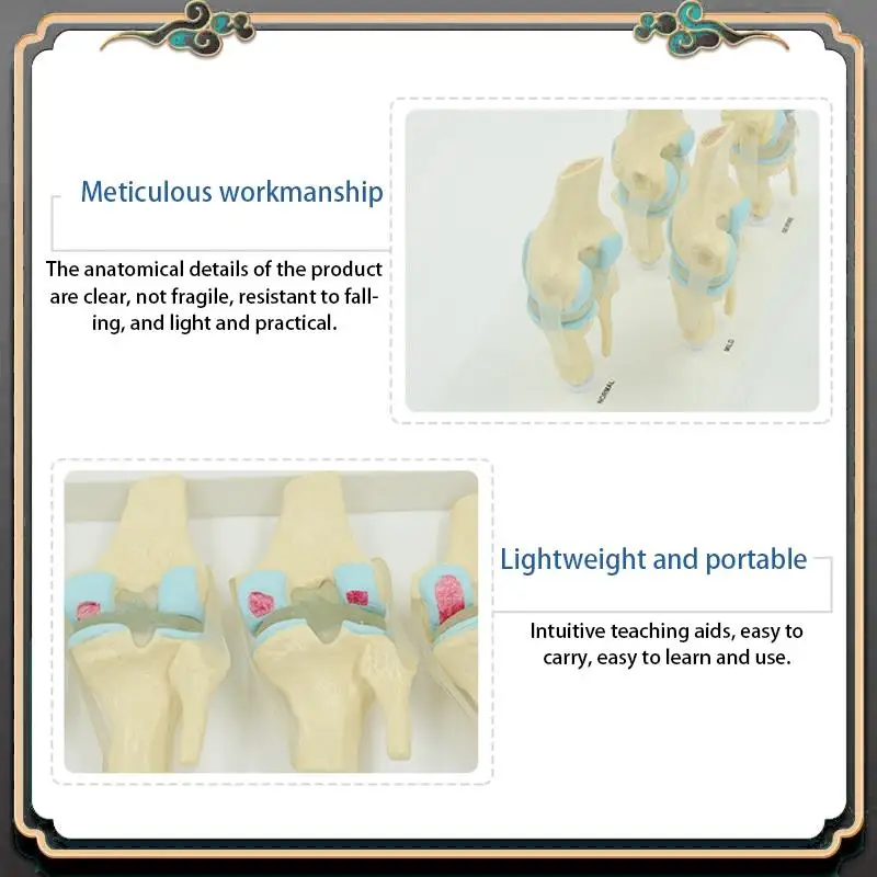 ASMA-Anatomical Human Degenerative Knee Joint Model Skeleton Anatomy Teaching Resources
ASMA-Anatomical Human Degenerative Knee Joint Model Skeleton Anatomy Teaching Resources