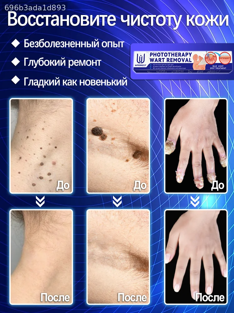 7-day quick treatment: Removes excess skin neoplasms.
7-day quick treatment: Removes excess skin neoplasms.
