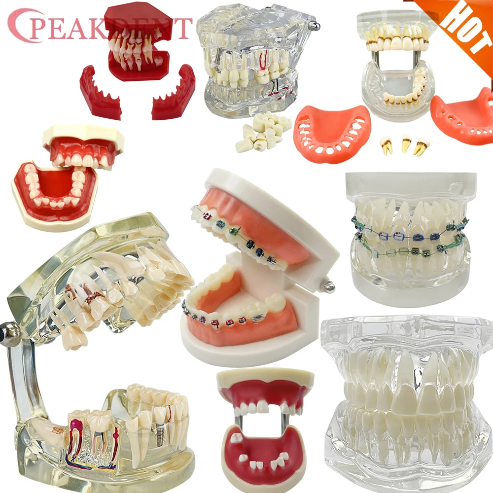 Multiple Types Dental Teeth Model Teaching Models Typodont Orthodontic Implant Restoration Bridge Model For Studying Demo
Multiple Types Dental Teeth Model Teaching Models Typodont Orthodontic Implant Restoration Bridge Model For Studying Demo
