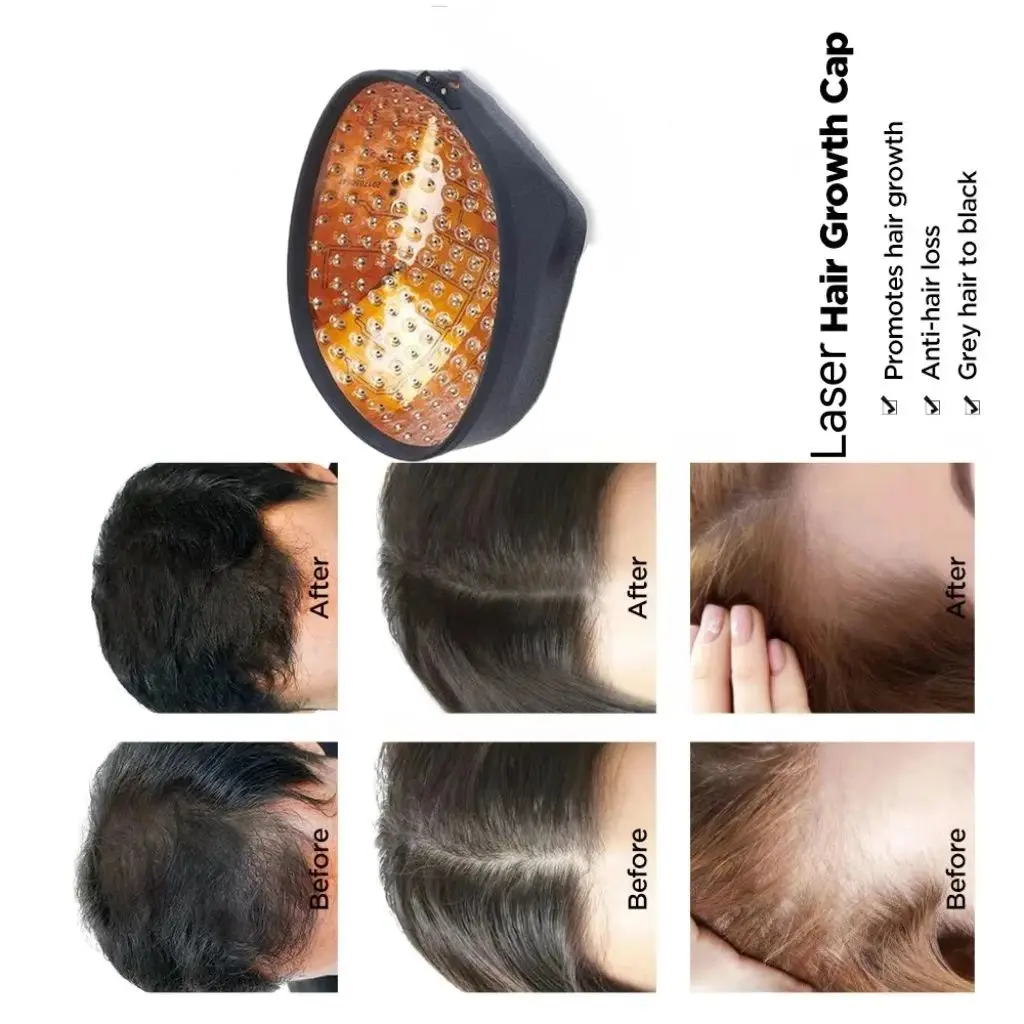 Laser Scalp Oil Control and Hair Growth, Hairline Remodeling Device, Sparse Top of The Head and Densification
Laser Scalp Oil Control and Hair Growth, Hairline Remodeling Device, Sparse Top of The Head and Densification