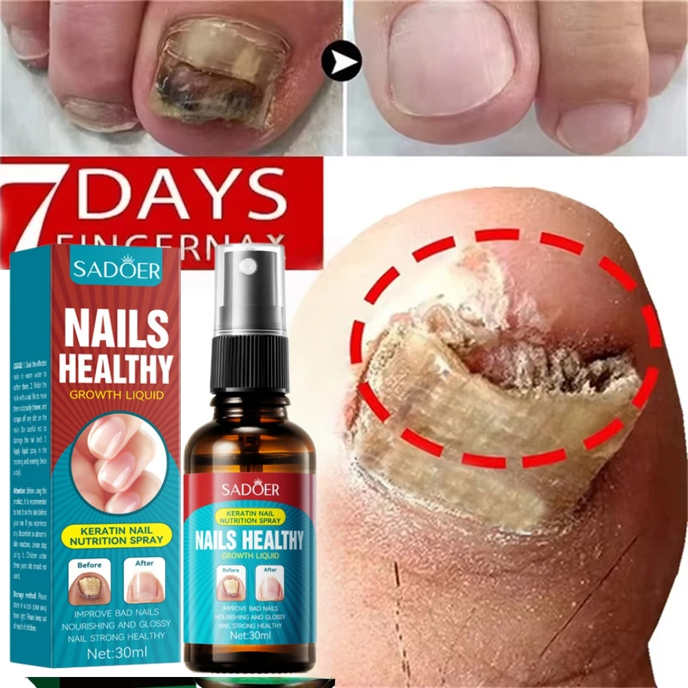Nail Fungus Care Solution Anti-Infection Onychomycosis Repair Serum Treatment Damage Crack Hand Foot Nail Manicureed Health Care
Nail Fungus Care Solution Anti-Infection Onychomycosis Repair Serum Treatment Damage Crack Hand Foot Nail Manicureed Health Care