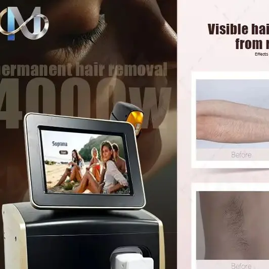 Alma Soprano Titanium 808 Diode Laser Hair Removal Machine 4-Wave Painless Permanent Portable 4000W Device
Alma Soprano Titanium 808 Diode Laser Hair Removal Machine 4-Wave Painless Permanent Portable 4000W Device