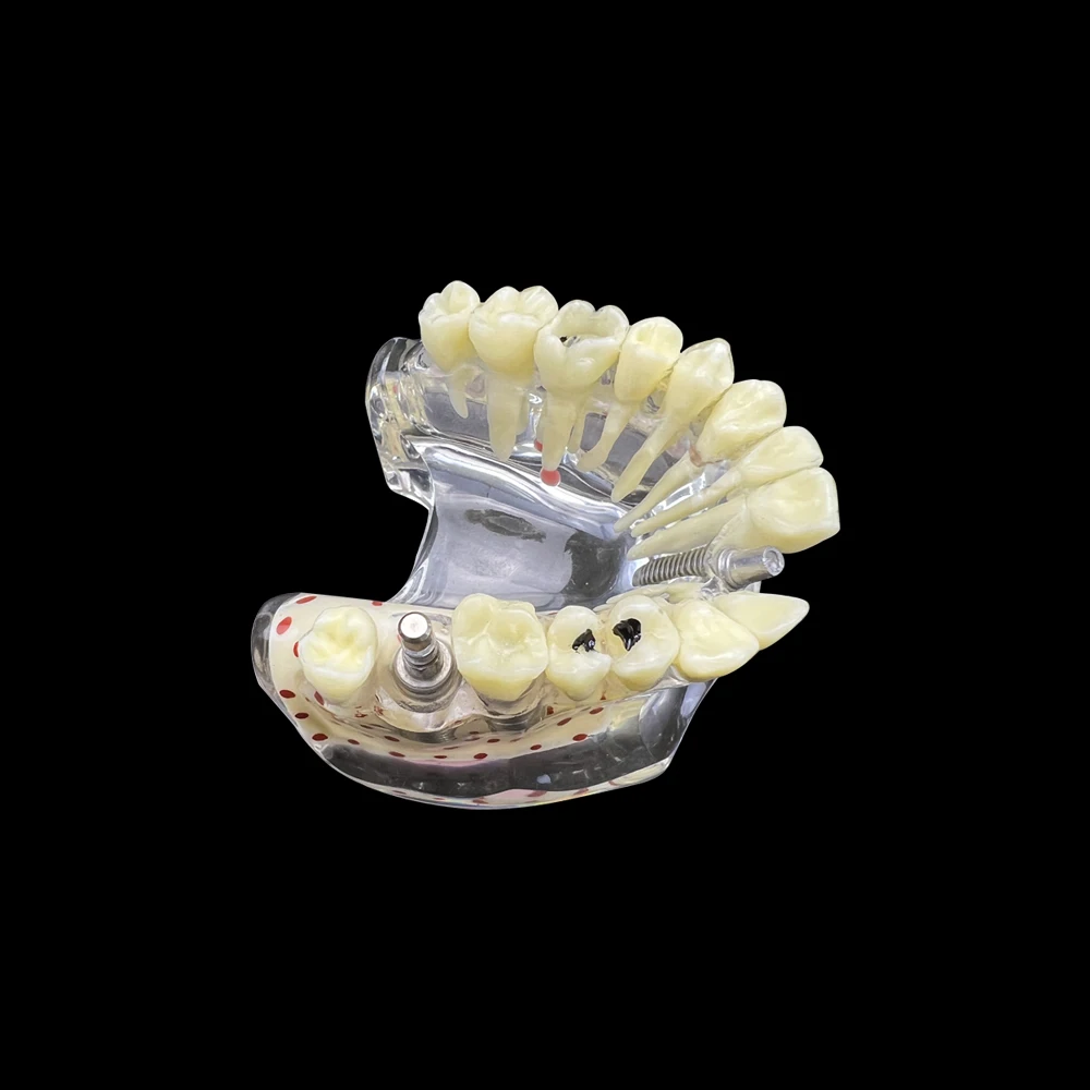 Стоматологическая верхняя стоматологическая модель с имплантатом прокидывания зубов и перелома корней, используемая для экспериментальной обучающей и обучающей модели
Стоматологическая верхняя стоматологическая модель с имплантатом прокидывания зубов и перелома корней, используемая для экспериментальной обучающей и обучающей модели