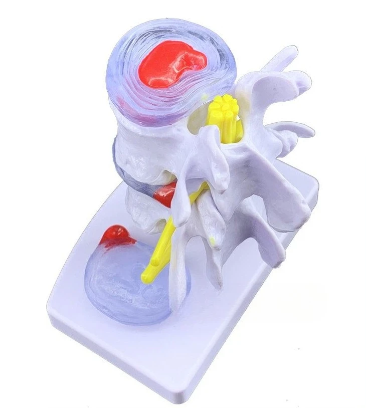 Disc herniation model Bone pathology model
Disc herniation model Bone pathology model