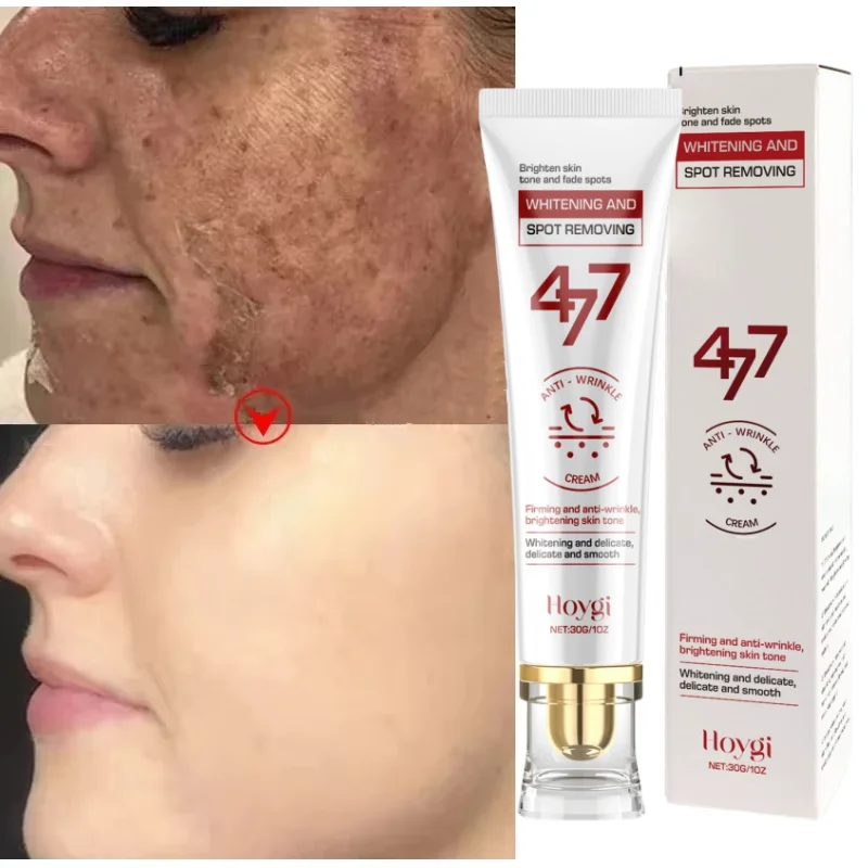Powerful Spot-Removing Whiten Cream Brighten Skin Fast Eliminates Melanin Pigmentation Melasma Dark Spots Korean Face Skin Care
Powerful Spot-Removing Whiten Cream Brighten Skin Fast Eliminates Melanin Pigmentation Melasma Dark Spots Korean Face Skin Care