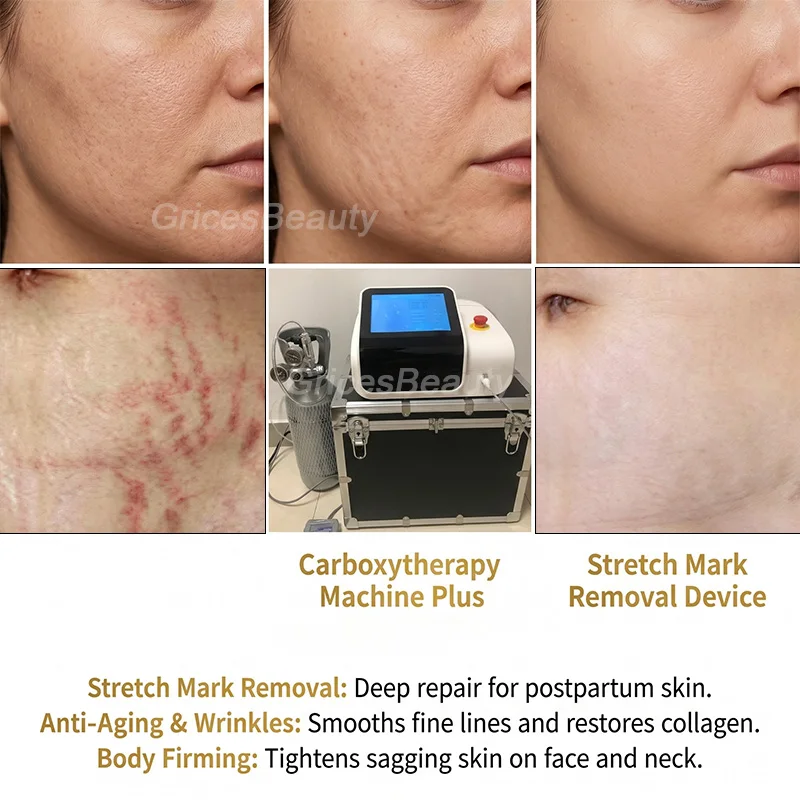Newest Heating CO2 Cdt Carboxytherapy Plus Device Skin Rejuvenation Professional Stretch Marks Remover Machine
Newest Heating CO2 Cdt Carboxytherapy Plus Device Skin Rejuvenation Professional Stretch Marks Remover Machine