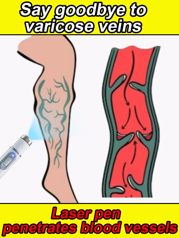 Painless laser treatment for varicose veins, phlebitis, poor blood circulation, promote circulation
Painless laser treatment for varicose veins, phlebitis, poor blood circulation, promote circulation