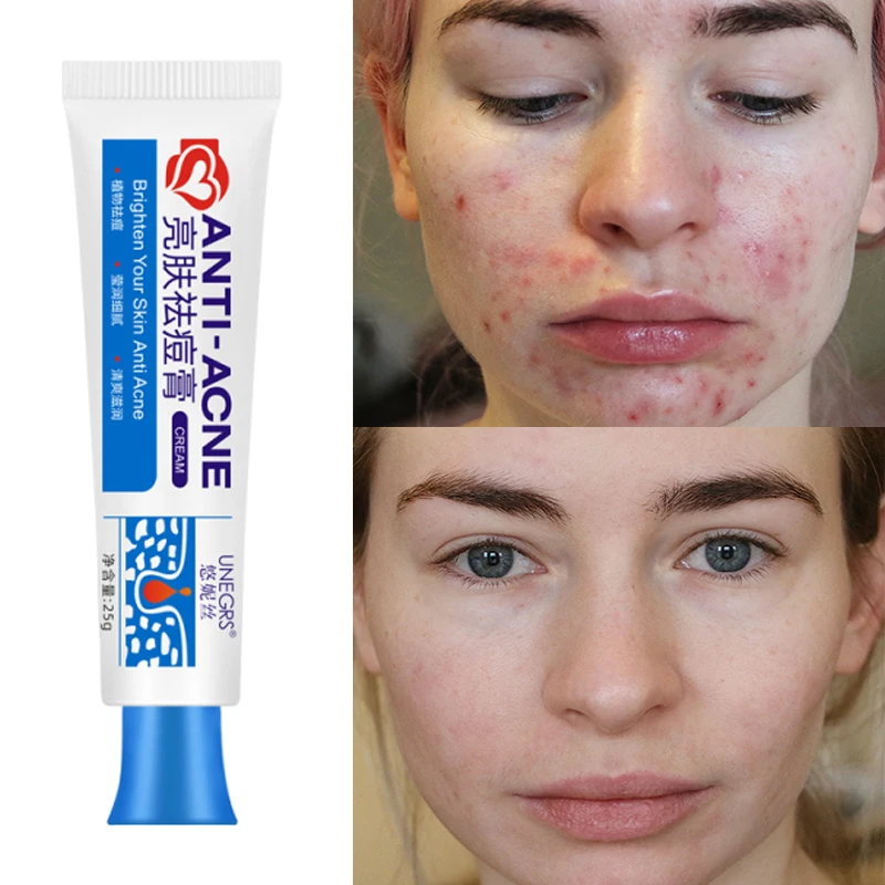 Salicylic Acid Anti Acne Treatment Cream Remove Acne Lighten Acne Marks Essence Shrink Pores Control Oil Moisturize Skin Care
Salicylic Acid Anti Acne Treatment Cream Remove Acne Lighten Acne Marks Essence Shrink Pores Control Oil Moisturize Skin Care