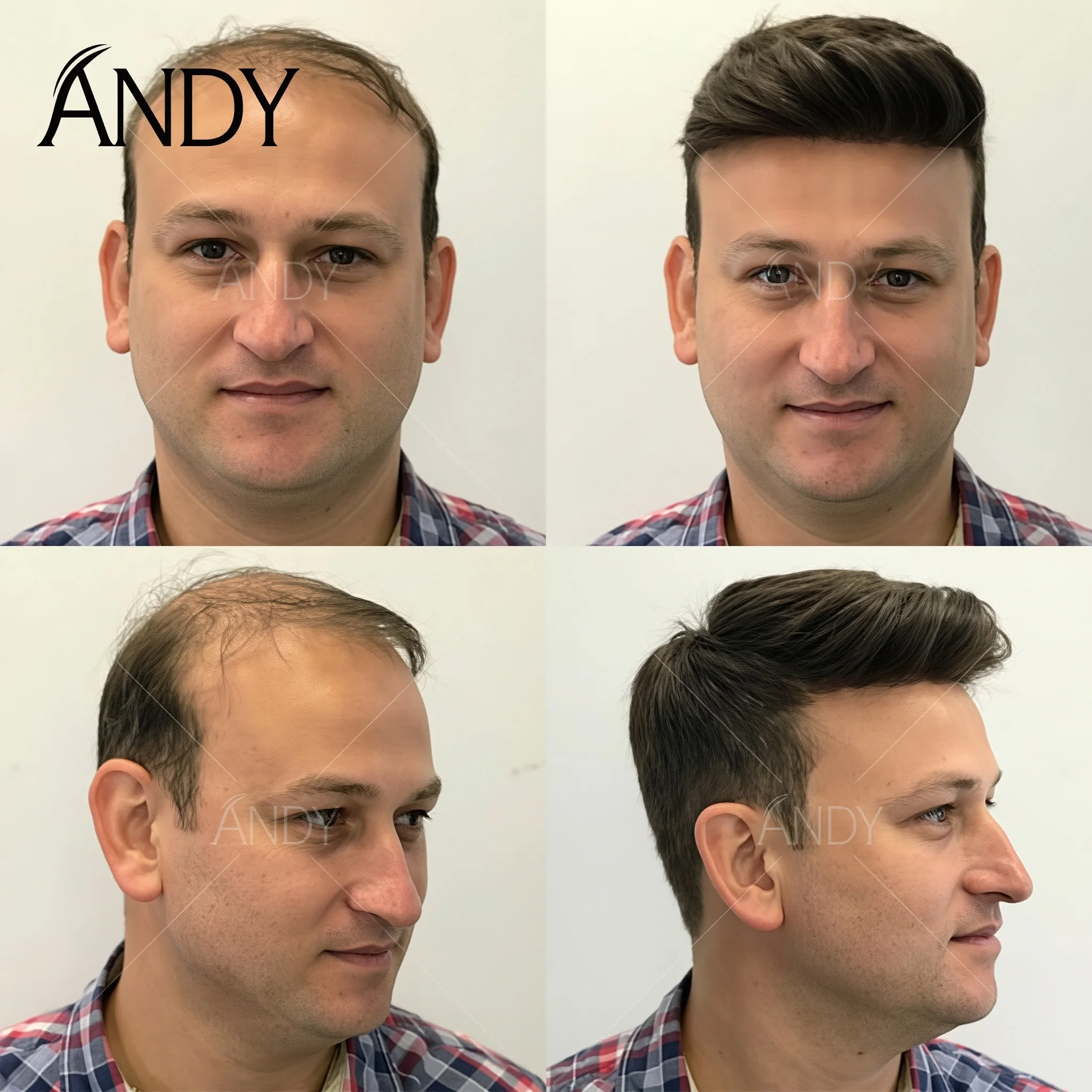 Thin Skin 0.06mm Men Toupee Comb Back Natural Human Hair Men Wig Indian Remy Hair Wig Toupee Hair Replacement Hair System
Thin Skin 0.06mm Men Toupee Comb Back Natural Human Hair Men Wig Indian Remy Hair Wig Toupee Hair Replacement Hair System