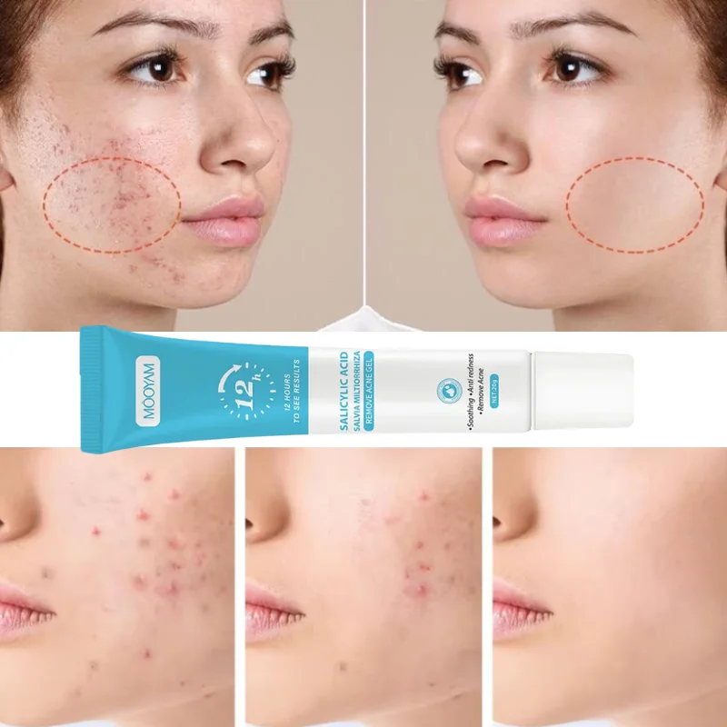 Acne Cream For Face Pimples Remover Treatment Shrink Pores Oil Control Lighten Acne Marks Whitening Smoothing Facial Skin Care
Acne Cream For Face Pimples Remover Treatment Shrink Pores Oil Control Lighten Acne Marks Whitening Smoothing Facial Skin Care