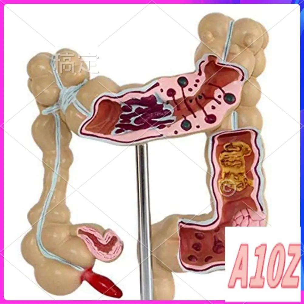 0Z-Colon Pathological Colorectal Cancer Model Large Intestine Model Gastrointestinal Anatomical Model
0Z-Colon Pathological Colorectal Cancer Model Large Intestine Model Gastrointestinal Anatomical Model