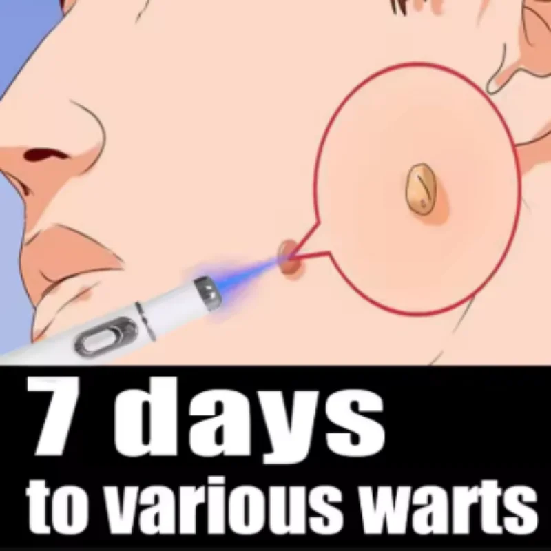 Quickly Remove Warts Painless Laser Tools 7 days Wart Blue Light tool Set Can says Goodbye To Flat Warts Filiform Warts
Quickly Remove Warts Painless Laser Tools 7 days Wart Blue Light tool Set Can says Goodbye To Flat Warts Filiform Warts