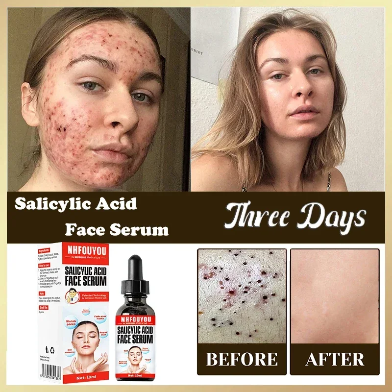 Salicylic Acid Solution Essence 10mL Shrink pores and Acne Spot Removing Shrink Pores Oil-Control Brighten Face Skin Makeup
Salicylic Acid Solution Essence 10mL Shrink pores and Acne Spot Removing Shrink Pores Oil-Control Brighten Face Skin Makeup