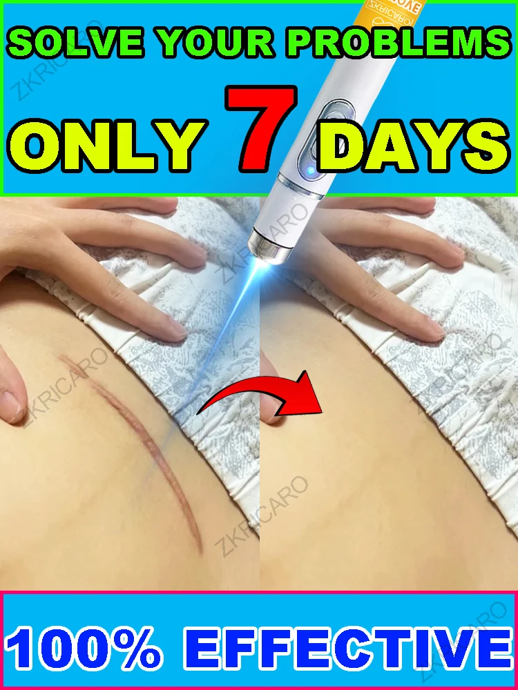 Медицинский синий свет,say прощаются шрамы!
Медицинский синий свет,say прощаются шрамы!