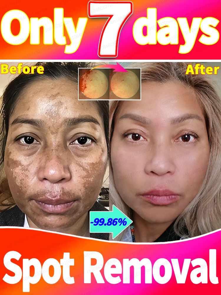 Gᴏᴏᴅʙʏᴇ ᴛᴏ Mᴇʟᴀsᴍᴀ For stubborn spots, we have the most effective 100% solution. 
Gᴏᴏᴅʙʏᴇ ᴛᴏ Mᴇʟᴀsᴍᴀ For stubborn spots, we have the most effective 100% solution.