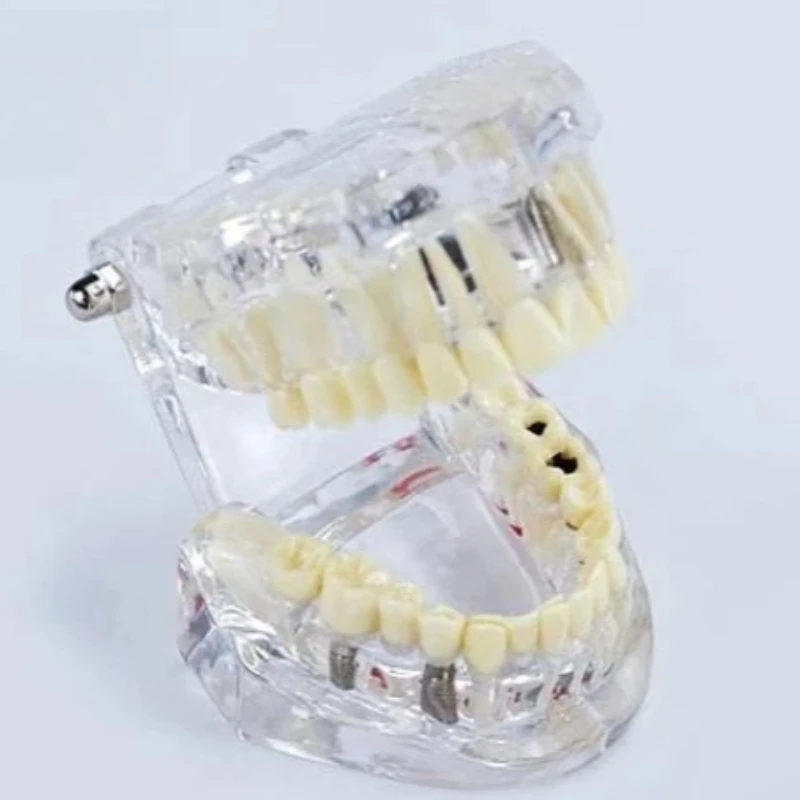 2Pcs Removable Teeth Model Implant Disease Dentist Studying Dental Model Teeth Implant Restoration Bridge Teaching Demonstration
2Pcs Removable Teeth Model Implant Disease Dentist Studying Dental Model Teeth Implant Restoration Bridge Teaching Demonstration