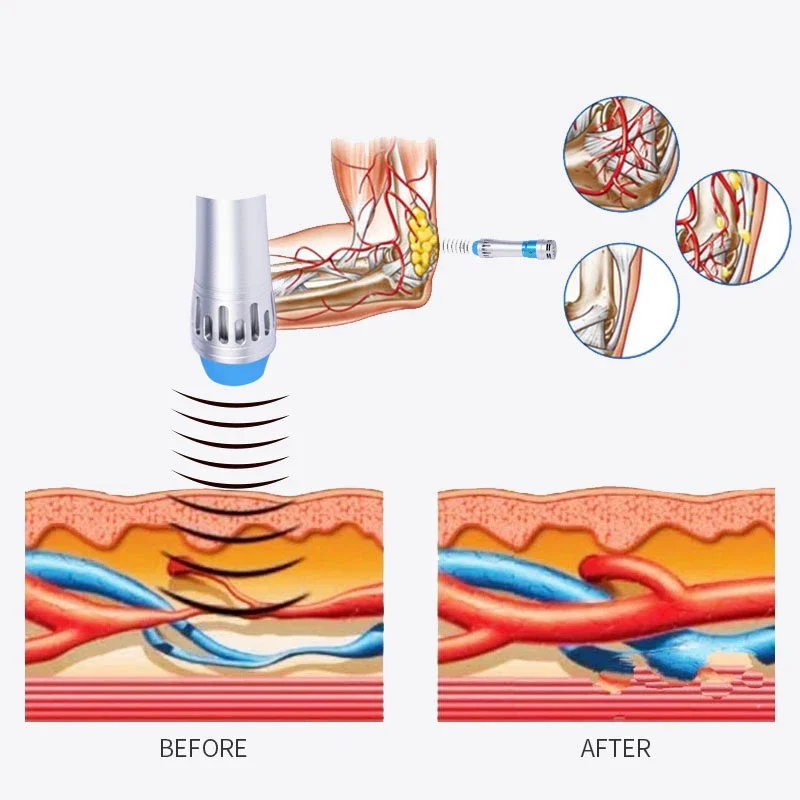 Handheld High Energy Linear Massager 7 Head Lattice Ballistic Wave Shock Therapy for Body Muscle Relaxation ED Cure
Handheld High Energy Linear Massager 7 Head Lattice Ballistic Wave Shock Therapy for Body Muscle Relaxation ED Cure