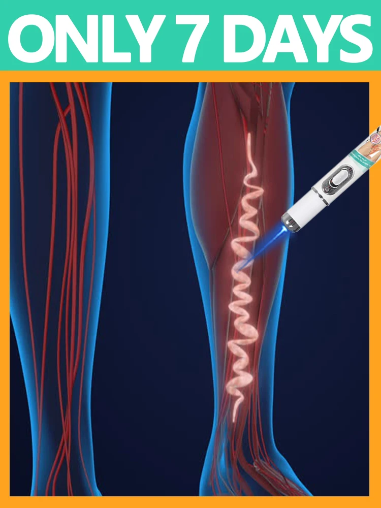 2026 hot sale Blue ray light pen Say Goodbye To all VEINS In 7 Days
2026 hot sale Blue ray light pen Say Goodbye To all VEINS In 7 Days