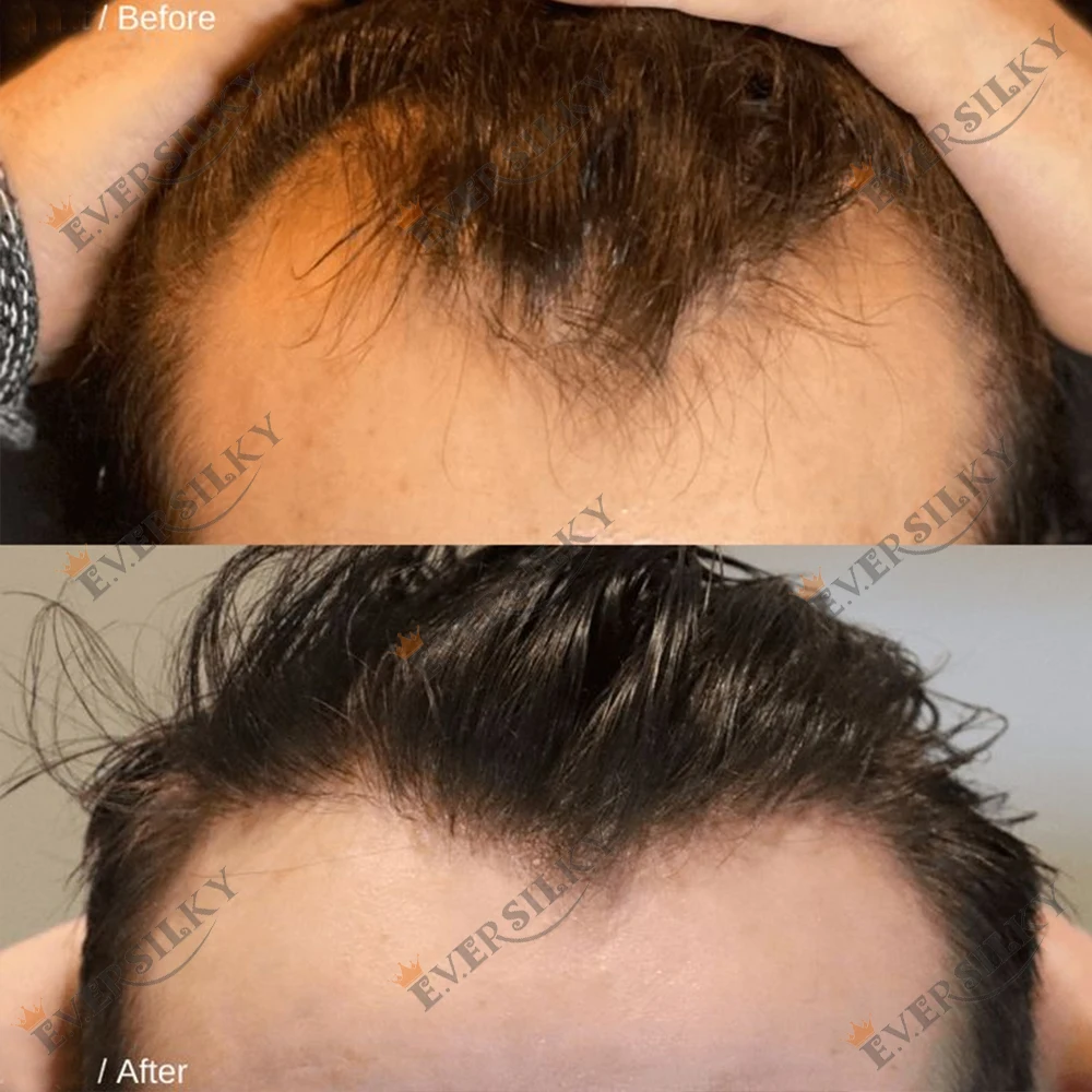 Супертонкое мужское париковое покрытие Vloop из ПУ и силикона, 0,02 мм, плотность 80, 210 шт. # 1B80 Белые серые блонд-оттенки, натуральные волосы Реми, незаметная линия роста волос
Супертонкое мужское париковое покрытие Vloop из ПУ и силикона, 0,02 мм, плотность 80, 210 шт. # 1B80 Белые серые блонд-оттенки, натуральные волосы Реми, незаметная линия роста волос 