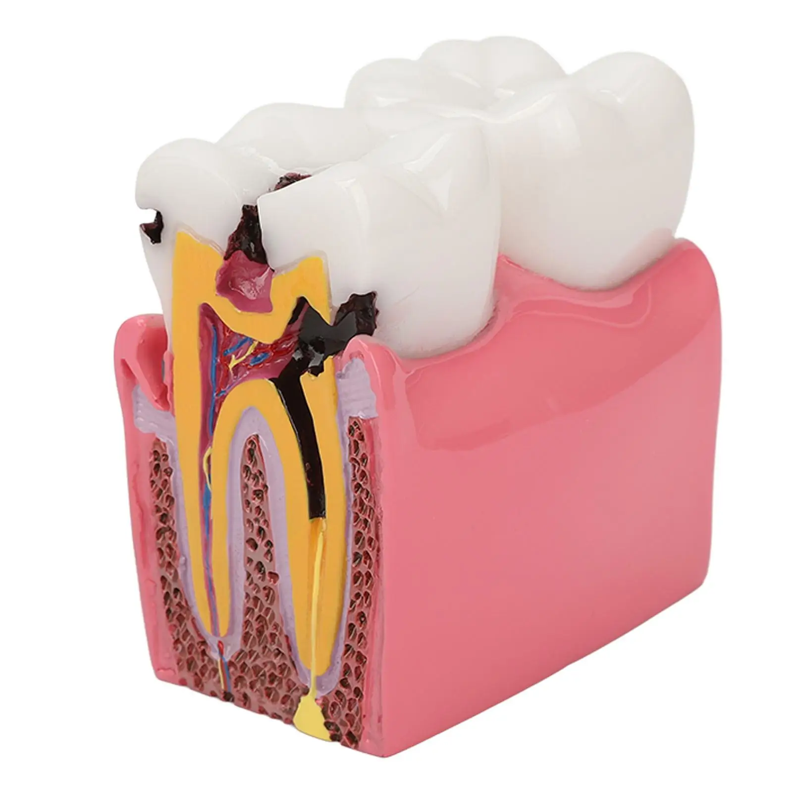 Dental Teaching Tool Bilateral Comparison Model 6X for Lab Use Educational Demonstration of Dental Caries
Dental Teaching Tool Bilateral Comparison Model 6X for Lab Use Educational Demonstration of Dental Caries