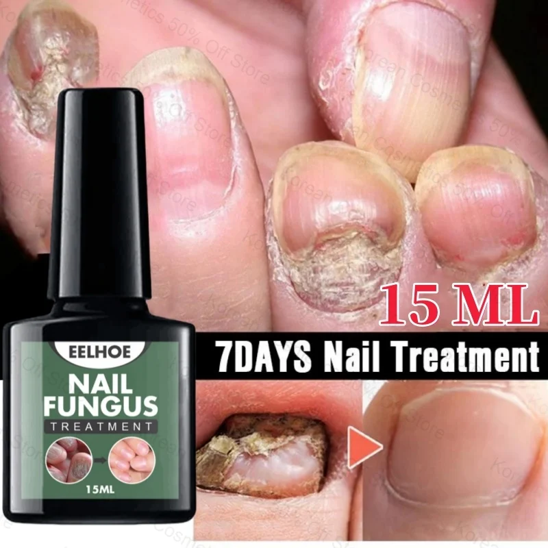 7 Days Nail Fungal Treatment Essence Oil Foot Toe Nail Fungus Removal Serum Repair Toenail Onychomycosi Gel Anti Infection Care
7 Days Nail Fungal Treatment Essence Oil Foot Toe Nail Fungus Removal Serum Repair Toenail Onychomycosi Gel Anti Infection Care