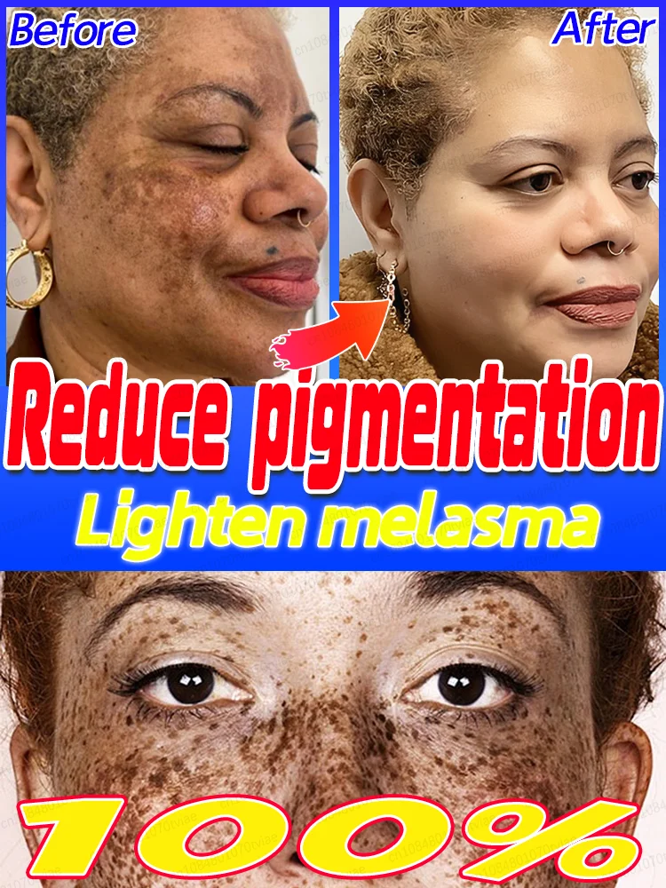 Технология подавления пигментации, борьба с веснушками Ниацинамид осветляет кожу, улучшает пигментацию, уменьшает веснушки.
Технология подавления пигментации, борьба с веснушками Ниацинамид осветляет кожу, улучшает пигментацию, уменьшает веснушки.