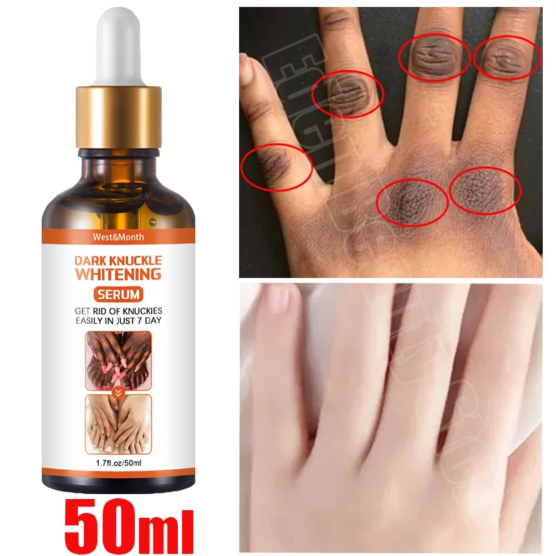 Быстроотбеливающая сыворотка Dark Knuckles, корректор суставов пальцев, локтей, колена, интенсивный меланин, товары для красоты, 50 мл
Быстроотбеливающая сыворотка Dark Knuckles, корректор суставов пальцев, локтей, колена, интенсивный меланин, товары для красоты, 50 мл
