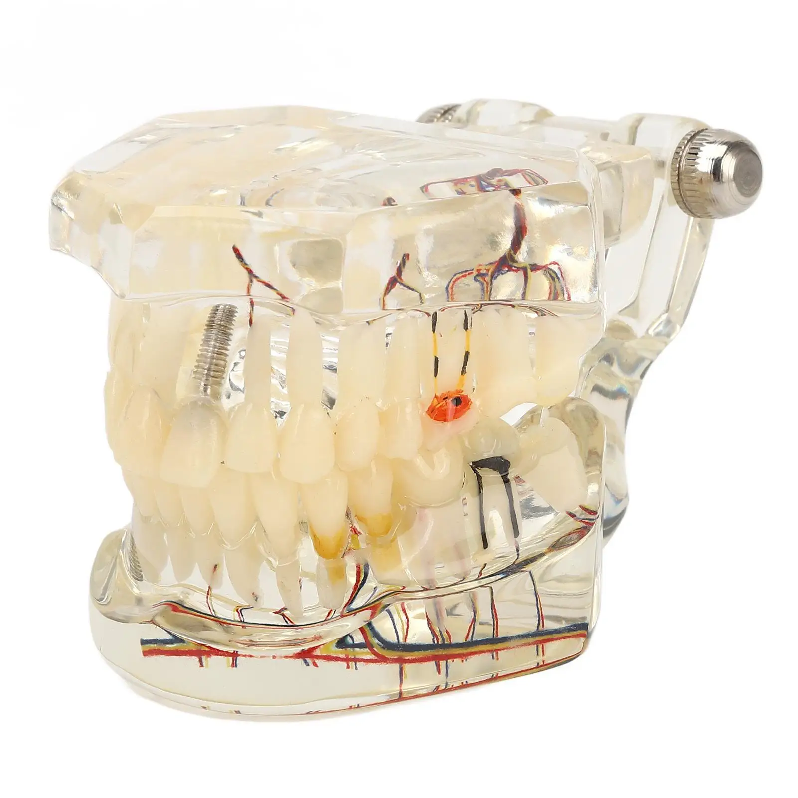 Portable Transparent Resin Dental Implant Disease Model for Teaching and for demonstration for Dentists
Portable Transparent Resin Dental Implant Disease Model for Teaching and for demonstration for Dentists