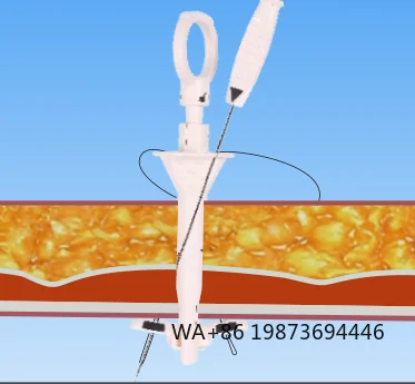 Disposable Fascial Closure Device, Needle-Based Wound Suture Surgical Supply
Disposable Fascial Closure Device, Needle-Based Wound Suture Surgical Supply