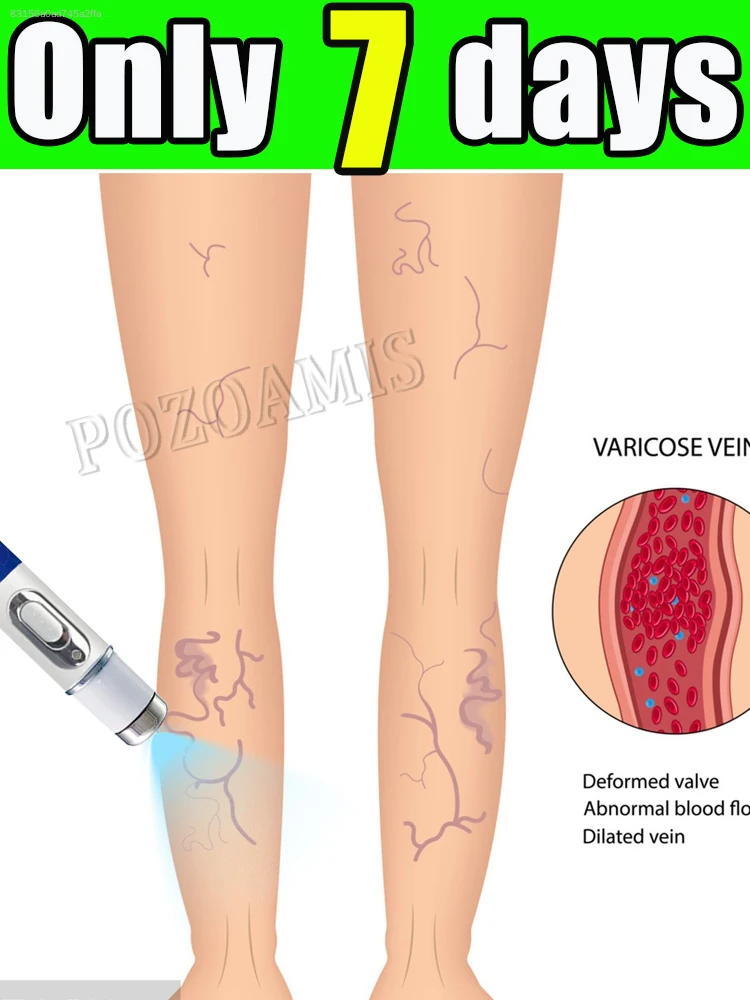Cultivating healthy legs: leg soreness and stiffness
Cultivating healthy legs: leg soreness and stiffness