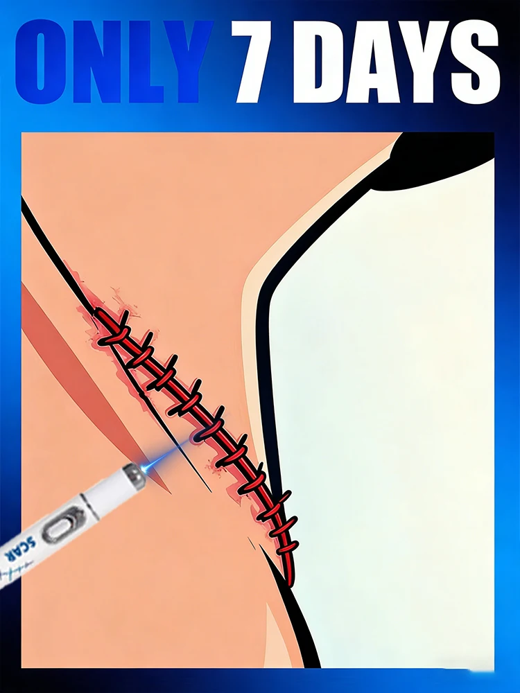 2 Generation Laser Pens to Fade Your Scars and Maintain Smooth Skin
2 Generation Laser Pens to Fade Your Scars and Maintain Smooth Skin