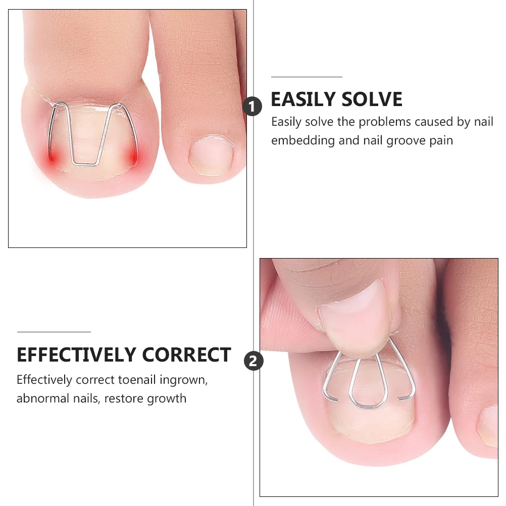 Nail Correction Tool Ingrown Toe Orthodontics Durable Premium Material Lightweight Compact Travel Size Paronychia Care Manicure
Nail Correction Tool Ingrown Toe Orthodontics Durable Premium Material Lightweight Compact Travel Size Paronychia Care Manicure