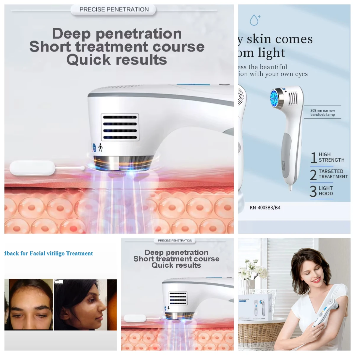 308nm Home Use Excimer KN-4003B4 Handheld Treatment with Cooling System
308nm Home Use Excimer KN-4003B4 Handheld Treatment with Cooling System