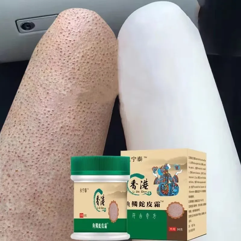 Chicken Skin Removal Treatment Body Cream Repair Keratosis Pilaris Rough Bumpy Pore Spots Moisturizing Whitening Dull Skin Care
Chicken Skin Removal Treatment Body Cream Repair Keratosis Pilaris Rough Bumpy Pore Spots Moisturizing Whitening Dull Skin Care